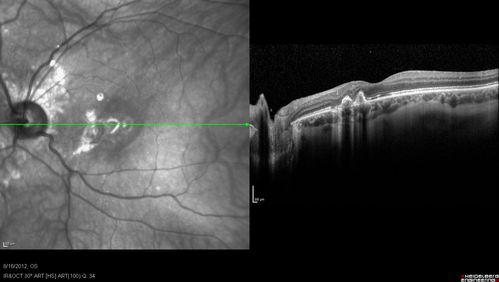 Punctate Inner Choroidopathy - Recurrent CNVM 4 years after initial treatment Left Eye - SDOCT
June 7, 2012.  This pleasant 35-year-old woman noticed decreasing vision in the left eye recently.   She returns now noticing the vision in the left eye is declining.   OD 20/50,  OS 20/80.  OS: Vertical C/D ratio is 0.3.  There is a scar just inferonasal to the fovea, which has grown some towards the fovea with a little blood just under the fovea.  


