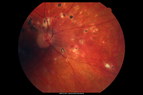 Punctate Inner Choroidopathy - Recurrent CNVM 4 years after initial treatment Left Eye 
June 7, 2012.  This pleasant 35-year-old woman noticed decreasing vision in the left eye recently.   She returns now noticing the vision in the left eye is declining.   OD 20/50,  OS 20/80.  OS: Vertical C/D ratio is 0.3.  There is a scar just inferonasal to the fovea, which has grown some towards the fovea with a little blood just under the fovea.  


