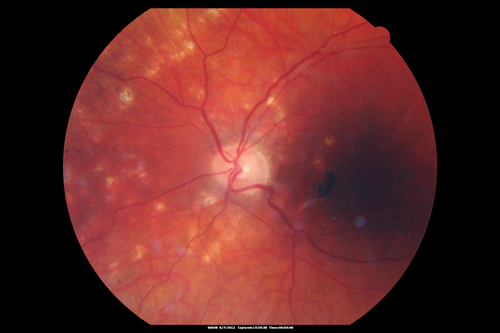 Punctate Inner Choroidopathy - Recurrent CNVM 4 years after initial treatment Left Eye 
June 7, 2012.  This pleasant 35-year-old woman noticed decreasing vision in the left eye recently.   She returns now noticing the vision in the left eye is declining.   OD 20/50,  OS 20/80.  OS: Vertical C/D ratio is 0.3.  There is a scar just inferonasal to the fovea, which has grown some towards the fovea with a little blood just under the fovea.  


