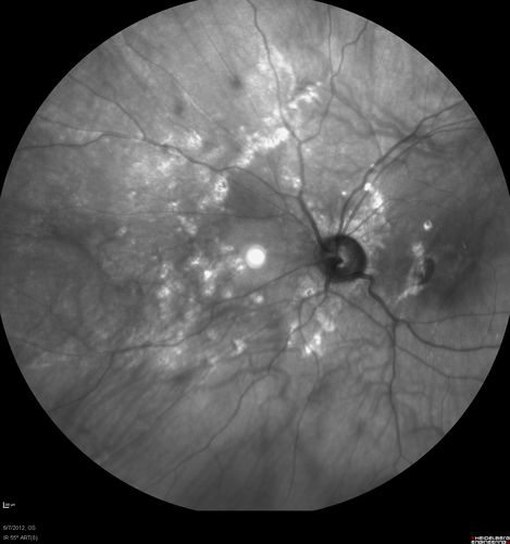 Punctate Inner Choroidopathy - Recurrent CNVM 4 years after initial treatment Left Eye 
June 7, 2012.  This pleasant 35-year-old woman noticed decreasing vision in the left eye recently.   She returns now noticing the vision in the left eye is declining.   OD 20/50,  OS 20/80.  OS: Vertical C/D ratio is 0.3.  There is a scar just inferonasal to the fovea, which has grown some towards the fovea with a little blood just under the fovea.  


