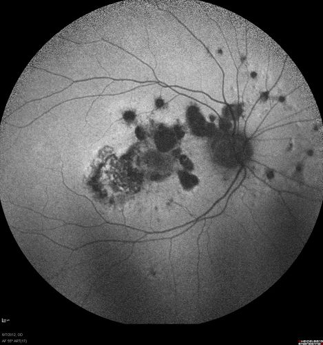 Punctate Inner Choroidopathy - Recurrent CNVM 4 years after initial treatment Left Eye - FAF
June 7, 2012.  This pleasant 35-year-old woman noticed decreasing vision in the left eye recently.   She returns now noticing the vision in the left eye is declining.   OD 20/50,  OS 20/80.  OS: Vertical C/D ratio is 0.3.  There is a scar just inferonasal to the fovea, which has grown some towards the fovea with a little blood just under the fovea.  


