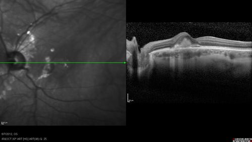 Punctate Inner Choroidopathy - Recurrent CNVM 4 years after initial treatment Left Eye - SD OCT
June 7, 2012.  This pleasant 35-year-old woman noticed decreasing vision in the left eye recently.   She returns now noticing the vision in the left eye is declining.   OD 20/50,  OS 20/80.  OS: Vertical C/D ratio is 0.3.  There is a scar just inferonasal to the fovea, which has grown some towards the fovea with a little blood just under the fovea.  


