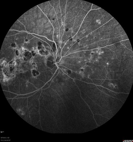 Punctate Inner Choroidopathy - Recurrent CNVM 4 years after initial treatment Left Eye  - Fluorescein Angiogram
June 7, 2012.  This pleasant 35-year-old woman noticed decreasing vision in the left eye recently.   She returns now noticing the vision in the left eye is declining.   OD 20/50,  OS 20/80.  OS: Vertical C/D ratio is 0.3.  There is a scar just inferonasal to the fovea, which has grown some towards the fovea with a little blood just under the fovea.  


