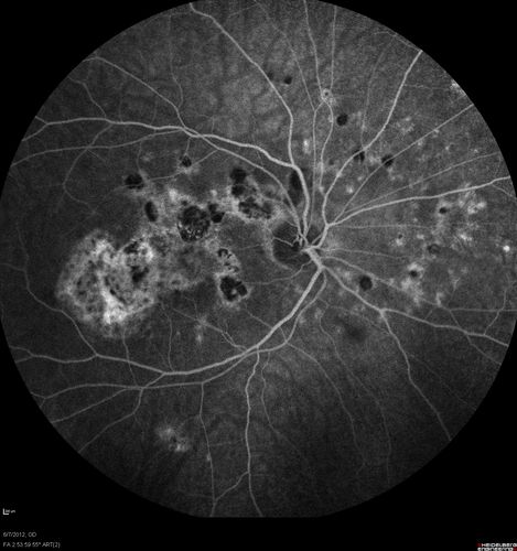 Punctate Inner Choroidopathy - Recurrent CNVM 4 years after initial treatment Left Eye  - Fluorescein Angiogram
June 7, 2012.  This pleasant 35-year-old woman noticed decreasing vision in the left eye recently.   She returns now noticing the vision in the left eye is declining.   OD 20/50,  OS 20/80.  OS: Vertical C/D ratio is 0.3.  There is a scar just inferonasal to the fovea, which has grown some towards the fovea with a little blood just under the fovea.  


