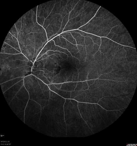 Punctate Inner Choroidopathy - Recurrent CNVM 4 years after initial treatment Left Eye  - Fluorescein Angiogram
June 7, 2012.  This pleasant 35-year-old woman noticed decreasing vision in the left eye recently.   She returns now noticing the vision in the left eye is declining.   OD 20/50,  OS 20/80.  OS: Vertical C/D ratio is 0.3.  There is a scar just inferonasal to the fovea, which has grown some towards the fovea with a little blood just under the fovea.  



