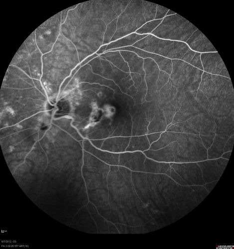 Punctate Inner Choroidopathy - Recurrent CNVM 4 years after initial treatment Left Eye  - Fluorescein Angiogram
June 7, 2012.  This pleasant 35-year-old woman noticed decreasing vision in the left eye recently.   She returns now noticing the vision in the left eye is declining.   OD 20/50,  OS 20/80.  OS: Vertical C/D ratio is 0.3.  There is a scar just inferonasal to the fovea, which has grown some towards the fovea with a little blood just under the fovea.  


