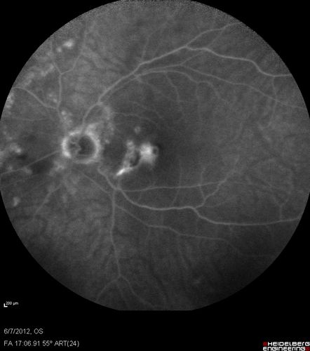 Punctate Inner Choroidopathy - Recurrent CNVM 4 years after initial treatment Left Eye - Fluorescein Angiogram
June 7, 2012.  This pleasant 35-year-old woman noticed decreasing vision in the left eye recently.   She returns now noticing the vision in the left eye is declining.   OD 20/50,  OS 20/80.  OS: Vertical C/D ratio is 0.3.  There is a scar just inferonasal to the fovea, which has grown some towards the fovea with a little blood just under the fovea.  


