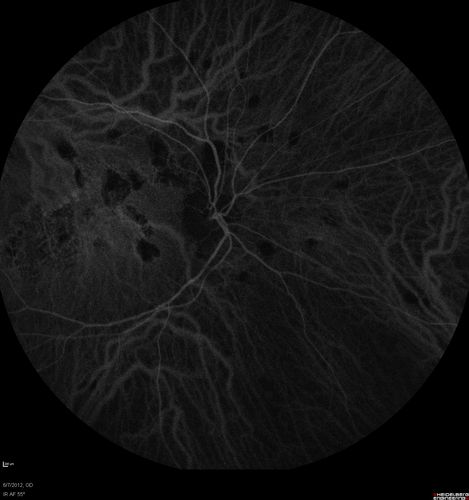 Punctate Inner Choroidopathy - Recurrent CNVM 4 years after initial treatment Left Eye - Indocyanine Green Angiogram
June 7, 2012.  This pleasant 35-year-old woman noticed decreasing vision in the left eye recently.   She returns now noticing the vision in the left eye is declining.   OD 20/50,  OS 20/80.  OS: Vertical C/D ratio is 0.3.  There is a scar just inferonasal to the fovea, which has grown some towards the fovea with a little blood just under the fovea.  


