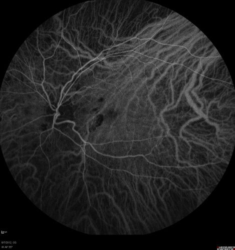 Punctate Inner Choroidopathy - Recurrent CNVM 4 years after initial treatment Left Eye - Indocyanine Green Angiogram
June 7, 2012.  This pleasant 35-year-old woman noticed decreasing vision in the left eye recently.   She returns now noticing the vision in the left eye is declining.   OD 20/50,  OS 20/80.  OS: Vertical C/D ratio is 0.3.  There is a scar just inferonasal to the fovea, which has grown some towards the fovea with a little blood just under the fovea.  


