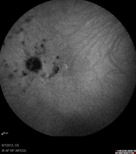Punctate Inner Choroidopathy - Recurrent CNVM 4 years after initial treatment Left Eye - Indocyanine Green Angiogram
June 7, 2012.  This pleasant 35-year-old woman noticed decreasing vision in the left eye recently.   She returns now noticing the vision in the left eye is declining.   OD 20/50,  OS 20/80.  OS: Vertical C/D ratio is 0.3.  There is a scar just inferonasal to the fovea, which has grown some towards the fovea with a little blood just under the fovea.  


