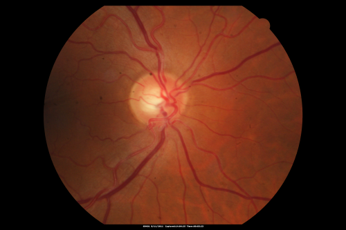 Anomalous Branch Retinal Artery 
59-year-old man  OD 20/25,  OS 20/25.  TORTUOUS RETINAL ARTERY â€“ LEF EYE 
(POSSIBLE GROUP 2 WYBURN-MASON SYNDROME
POSSIBLE ACEPHALIC MIGRAINES )
