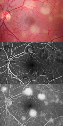 Acute posterior multifocal placoid pigment epitheliopathy
