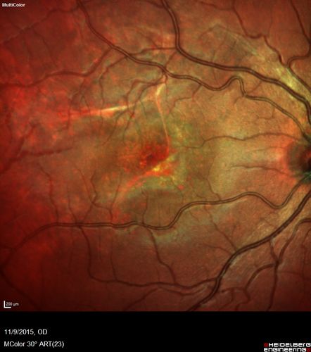 Acute Posterior Multifocal Placoid Pigment Epitheliopathy - 4 years after onset
4 years after presentation - vision 20/80 OD 20/16 OS and there is subretinal fibrosis
