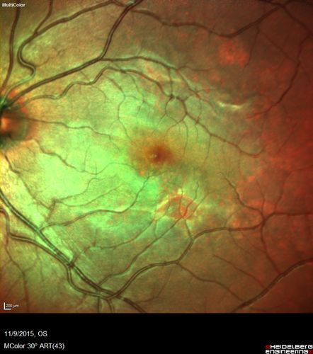 Acute Posterior Multifocal Placoid Pigment Epitheliopathy - 4 years after onset
4 years after presentation - vision 20/80 OD 20/16 OS and there is subretinal fibrosis
