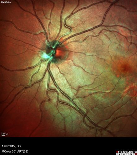 Acute Posterior Multifocal Placoid Pigment Epitheliopathy - 4 years after onset
4 years after presentation - vision 20/80 OD 20/16 OS and there is subretinal fibrosis
