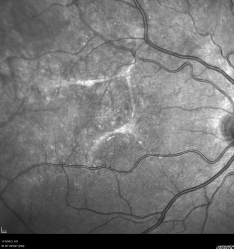 Acute Posterior Multifocal Placoid Pigment Epitheliopathy - 4 years after onset
4 years after presentation - vision 20/80 OD 20/16 OS and there is subretinal fibrosis
