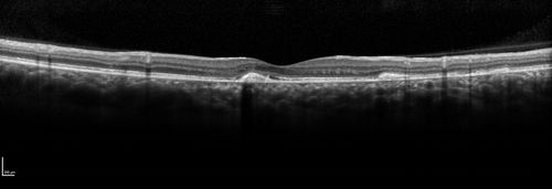 Acute Posterior Multifocal Placoid Pigment Epitheliopathy - 4 years after onset
4 years after presentation - vision 20/80 OD 20/16 OS and there is subretinal fibrosis
