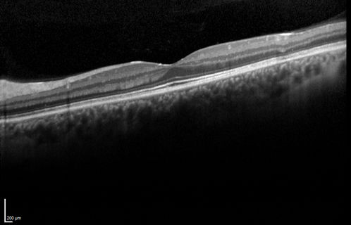 Acute Posterior Multifocal Placoid Pigment Epitheliopathy - 4 years after onset
4 years after presentation - vision 20/80 OD 20/16 OS and there is subretinal fibrosis
