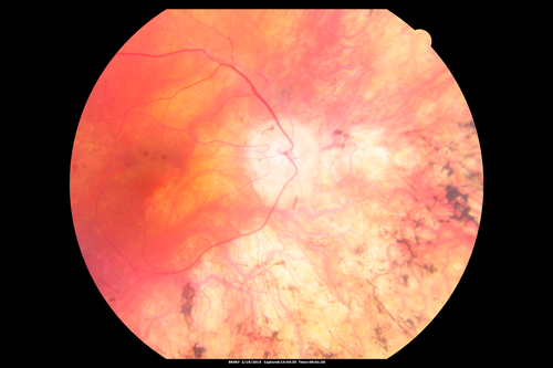 Retinitis Pigmentosa - Autosomal Recessive - 82 year old man with Good Vision
VA 20/25, 20/32 - Bone spicules in periphery - FAF is very symmetric
