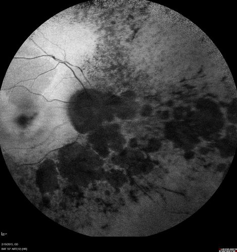 Retinitis Pigmentosa - Autosomal Recessive - 82 year old man with Good Vision
VA 20/25, 20/32 - Bone spicules in periphery - FAF is very symmetric
