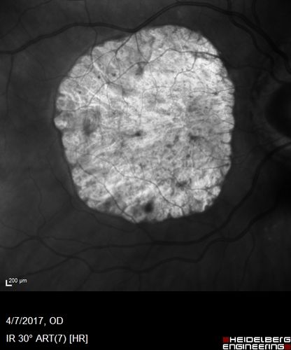 Central Areolar Choroidal Sclerosis
66 year old woman with 20/160 vision - loss of central vision 11 years ago.  Strong family history of vision loss.
