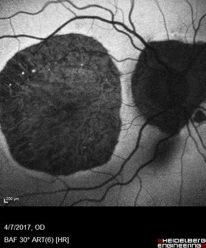 Central Areolar Choroidal Sclerosis
66 year old woman with 20/160 vision - loss of central vision 11 years ago.  Strong family history of vision loss.
