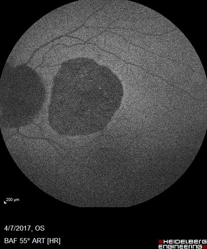 Central Areolar Choroidal Sclerosis
66 year old woman with 20/160 vision - loss of central vision 11 years ago.  Strong family history of vision loss.
