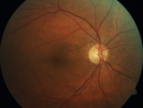 Primary Toxoplasmosis
76 year old man with blurred vision left eye.  He improved to 20/25 in 2 months with valtrex.  No steroids were given
