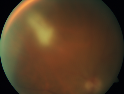 Primary Toxoplasmosis
76 year old man with blurred vision left eye.  He improved to 20/25 in 2 months with valtrex.  No steroids were given
