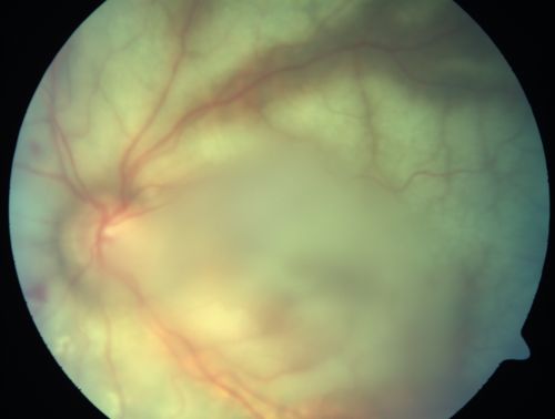 Progressive Outer Retinal Necrosis 77 Year Old Woman with CLL (Acute Retinal Necrosis) (PORN - ARN)
77-year-old woman with CLL who had shingles on the left side of her face about 6 weeks ago then she developed a dendrite in the cornea which was treating about four weeks ago.  She noticed severe vision loss in the left eye just a few days ago and you saw retinitis and she comes in because of that.   Vision OD is 20/25, OS is hand motion
