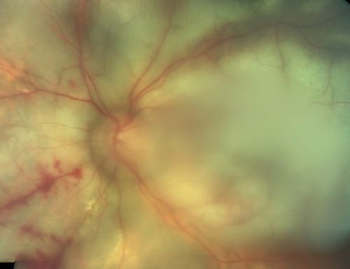 Progressive Outer Retinal Necrosis 77 Year Old Woman with CLL (Acute Retinal Necrosis) (PORN - ARN)
77-year-old woman with CLL who had shingles on the left side of her face about 6 weeks ago then she developed a dendrite in the cornea which was treating about four weeks ago.  She noticed severe vision loss in the left eye just a few days ago and you saw retinitis and she comes in because of that.   Vision OD is 20/25, OS is hand motion
