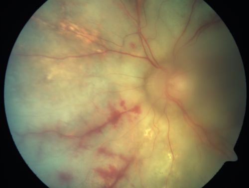Progressive Outer Retinal Necrosis 77 Year Old Woman with CLL (Acute Retinal Necrosis) (PORN - ARN)
77-year-old woman with CLL who had shingles on the left side of her face about 6 weeks ago then she developed a dendrite in the cornea which was treating about four weeks ago.  She noticed severe vision loss in the left eye just a few days ago and you saw retinitis and she comes in because of that.   Vision OD is 20/25, OS is hand motion
