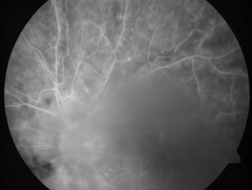 Progressive Outer Retinal Necrosis 77 Year Old Woman with CLL (Acute Retinal Necrosis) (PORN - ARN)
77-year-old woman with CLL who had shingles on the left side of her face about 6 weeks ago then she developed a dendrite in the cornea which was treating about four weeks ago.  She noticed severe vision loss in the left eye just a few days ago and you saw retinitis and she comes in because of that.   Vision OD is 20/25, OS is hand motion
