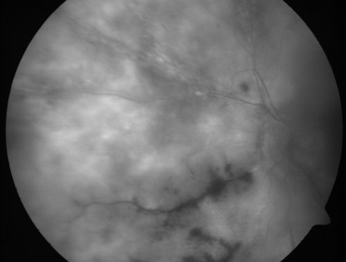 Progressive Outer Retinal Necrosis 77 Year Old Woman with CLL (Acute Retinal Necrosis) (PORN - ARN)
77-year-old woman with CLL who had shingles on the left side of her face about 6 weeks ago then she developed a dendrite in the cornea which was treating about four weeks ago.  She noticed severe vision loss in the left eye just a few days ago and you saw retinitis and she comes in because of that.   Vision OD is 20/25, OS is hand motion
