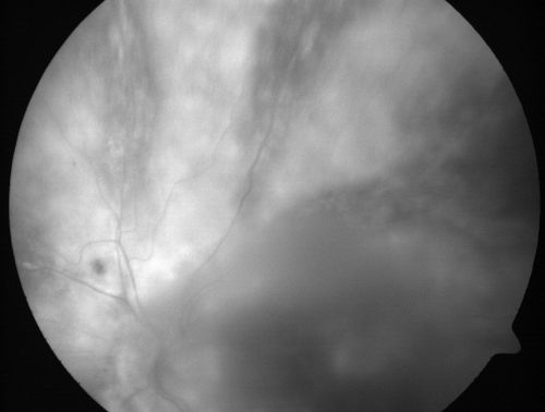 Progressive Outer Retinal Necrosis 77 Year Old Woman with CLL (Acute Retinal Necrosis) (PORN - ARN)
77-year-old woman with CLL who had shingles on the left side of her face about 6 weeks ago then she developed a dendrite in the cornea which was treating about four weeks ago.  She noticed severe vision loss in the left eye just a few days ago and you saw retinitis and she comes in because of that.   Vision OD is 20/25, OS is hand motion
