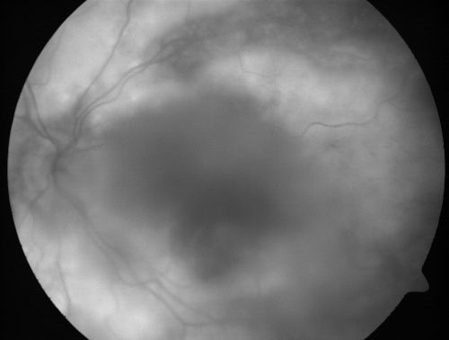 Progressive Outer Retinal Necrosis 77 Year Old Woman with CLL (Acute Retinal Necrosis) (PORN - ARN)
77-year-old woman with CLL who had shingles on the left side of her face about 6 weeks ago then she developed a dendrite in the cornea which was treating about four weeks ago.  She noticed severe vision loss in the left eye just a few days ago and you saw retinitis and she comes in because of that.   Vision OD is 20/25, OS is hand motion
