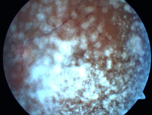 Asteroid Hyalosis - Benign Calcified Deposits in the Vitreous
75 year old woman with 20/30 vision and dense asteroid haylosis
Keywords: vitreous; asteroid hyalosis