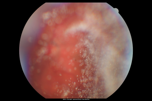 Asteroid Hyalosis - Asymptomatic
80-year-old woman her vision is not bothering her, you noticed a problem with the retina. Her left eye tests worse than the right eye today, but she says that it has been like that for a long time and she is not bothered by any floaters or change in central vision.
VISUAL ACUITY: OD is 20/25, OS 20/40
Keywords: floaters;asteroid;