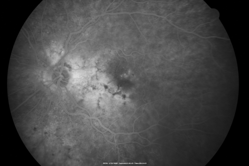 Asteroid Hyalosis - Asymptomatic
80-year-old woman her vision is not bothering her, you noticed a problem with the retina. Her left eye tests worse than the right eye today, but she says that it has been like that for a long time and she is not bothered by any floaters or change in central vision.
VISUAL ACUITY: OD is 20/25, OS 20/40
Keywords: floaters;asteroid;