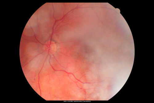 Asteroid Hyalosis - Asymptomatic
80-year-old woman her vision is not bothering her, you noticed a problem with the retina. Her left eye tests worse than the right eye today, but she says that it has been like that for a long time and she is not bothered by any floaters or change in central vision.
VISUAL ACUITY: OD is 20/25, OS 20/40
Keywords: floaters;asteroid;