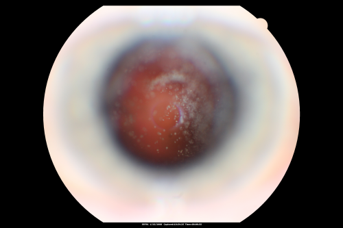 Asteroid Hyalosis - Asymptomatic
80-year-old woman her vision is not bothering her, you noticed a problem with the retina. Her left eye tests worse than the right eye today, but she says that it has been like that for a long time and she is not bothered by any floaters or change in central vision.
VISUAL ACUITY: OD is 20/25, OS 20/40
Keywords: floaters;asteroid;