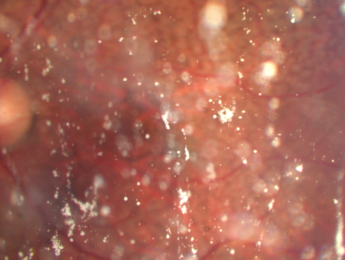 Asteroid Hyalosis Before Vitrectomy 
80 year old woman with decreased vision and blurring in the left eye for the past year.  She reports that she has blurring that comes and goes and floaters that bother her when she reads.  
  

The patient reports that the floaters that bother her have been occurring on a daily basis lately.  She reports that she is having a â€œhard time readingâ€.   Visual acuity with correction 20/30-3 OD and 20/30-2 
