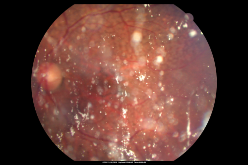 Asteroid Hyalosis Before Vitrectomy
80 year old woman with decreased vision and blurring in the left eye for the past year.  She reports that she has blurring that comes and goes and floaters that bother her when she reads.  
  

The patient reports that the floaters that bother her have been occurring on a daily basis lately.  She reports that she is having a â€œhard time readingâ€.  
 Visual acuity with correction 20/30-3 OD and 20/30-2 
