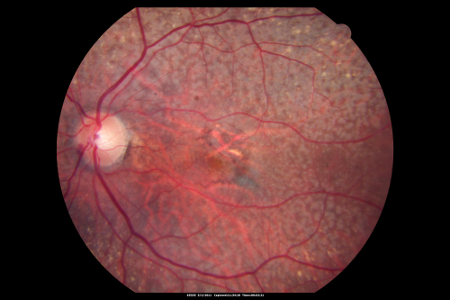 80 year old woman with Reticular Drusen (pseudodrusen) 20/30 Vision
80 year old woman with asteroid hyalosis and macular degeneration.

OPHTHALMIC EXAMINATION: Visual acuity with correction 20/30-3 OD and 20/30-2 
