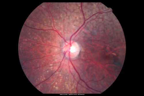 Asteroid Hyalosis After Vitrectomy (also reticular drusen)
