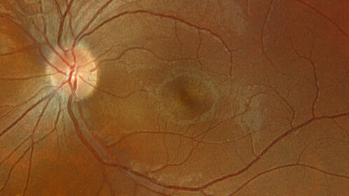 Astrocytoma (Astrocytic Hamartoma) no calcification
38 year old man with no symptoms
