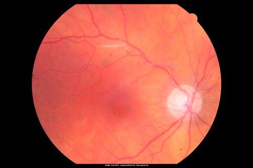 Branch Retinal Arterial Occlusion Right Eye - Atheromata - Both Eyes
83 year old woman with no symptoms - VA 20/40 in both eyes.  Right eye has ST BRAO with silver wiring.  Left eye has superotemporal atheromata
