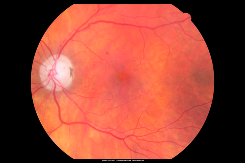 Branch Retinal Arterial Occlusion Right Eye - Atheromata - Both Eyes
83 year old woman with no symptoms - VA 20/40 in both eyes.  Right eye has ST BRAO with silver wiring.  Left eye has superotemporal atheromata
