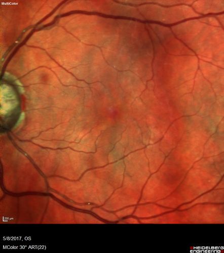 Branch Retinal Arterial Occlusion Right Eye - Atheromata - Both Eyes
83 year old woman with no symptoms - VA 20/40 in both eyes.  Right eye has ST BRAO with silver wiring.  Left eye has superotemporal atheromata
