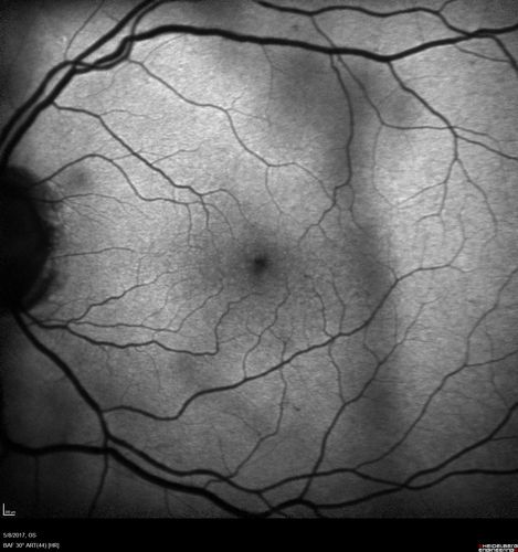 Branch Retinal Arterial Occlusion Right Eye - Atheromata - Both Eyes
83 year old woman with no symptoms - VA 20/40 in both eyes.  Right eye has ST BRAO with silver wiring.  Left eye has superotemporal atheromata
